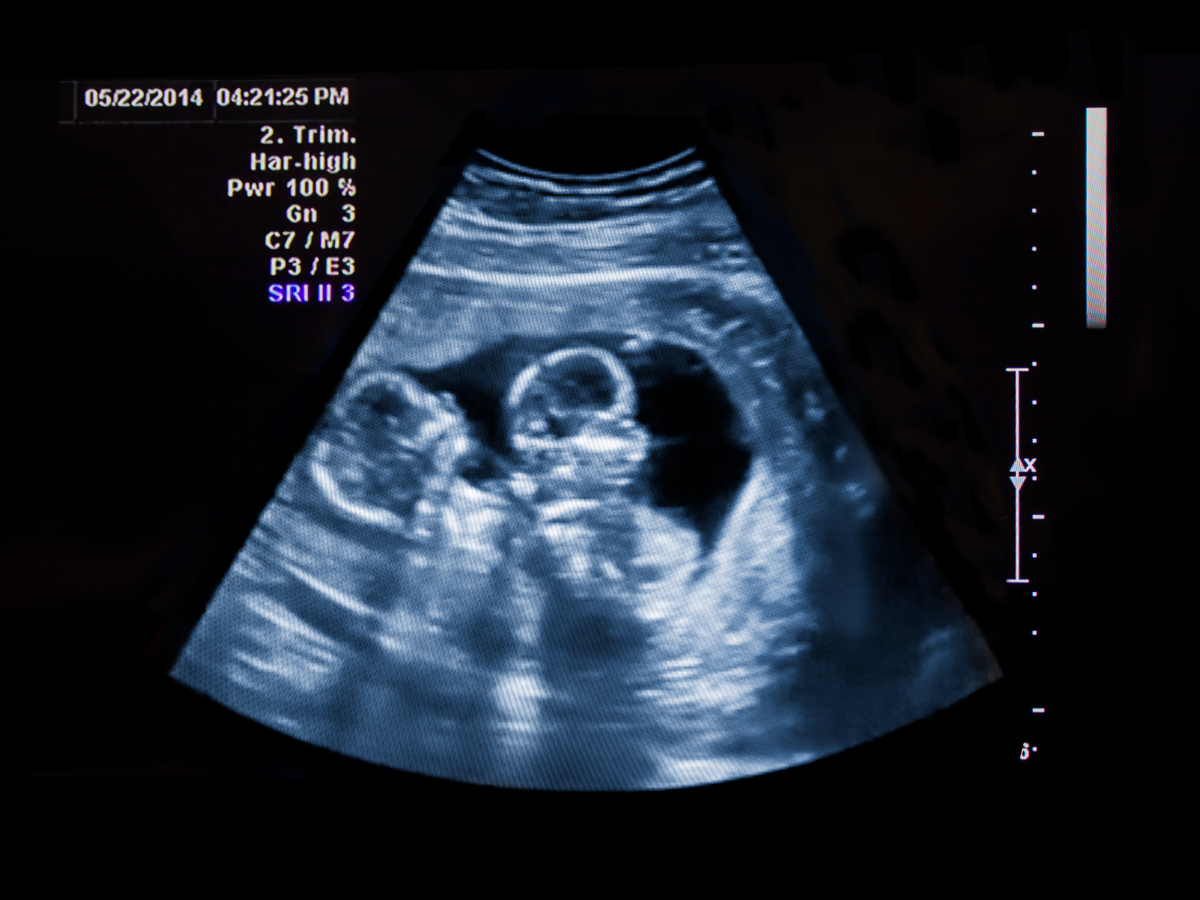 When Can You See Twins on Ultrasound? Early Signs EasyJug