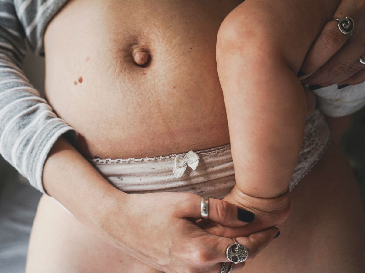 Treatments to Get Rid of C-Section Belly Pouch