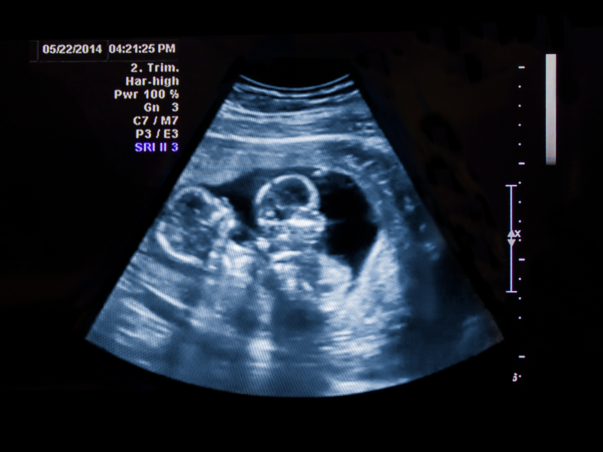 when can you see twins on ultrasound